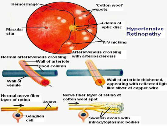 eye-disease-caused-by-high-blood-pressure-ucbmsh-org